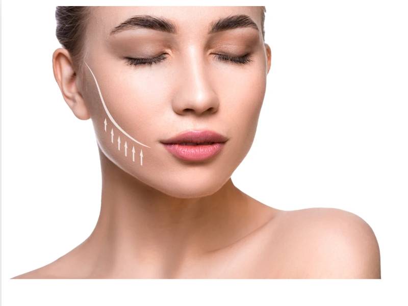 藍鑽魚骨線臉部拉提埋線｜自然立體緊緻輪廓