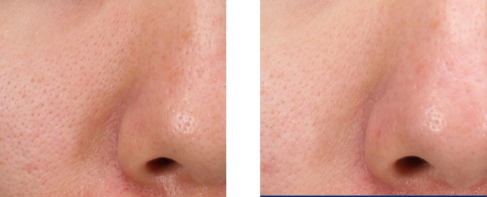 縮小毛孔 微針.jpg